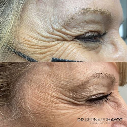 Dr Bernard Hayot - Blépharoplastie & Lipofilling du Regard