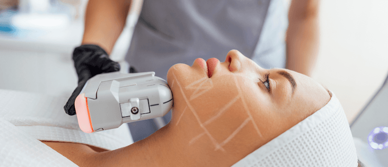 Lifting sans chirurgie hifu paris