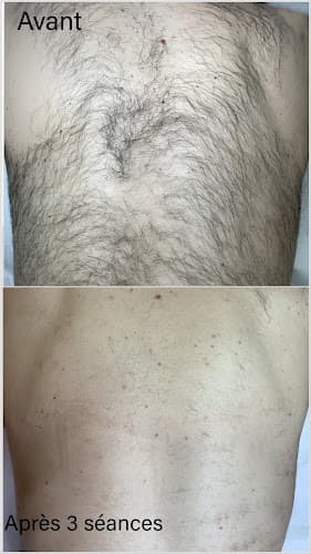 EXO épilation laser - Épilation Définitive & Maquillage Permanent à Toulon