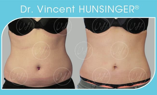 Dr Vincent Hunsinger Cosmetic Surgeon